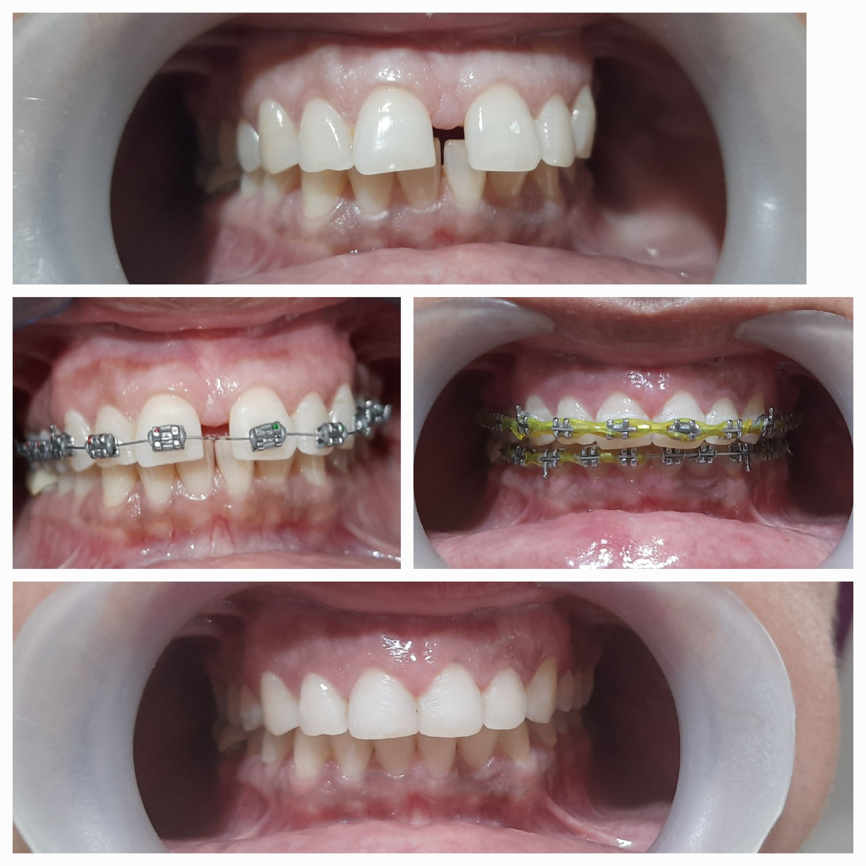 Spreading Smilez-Dr Bhalla's Multispeciality Dental Clinic Zirakpur Chandigarh