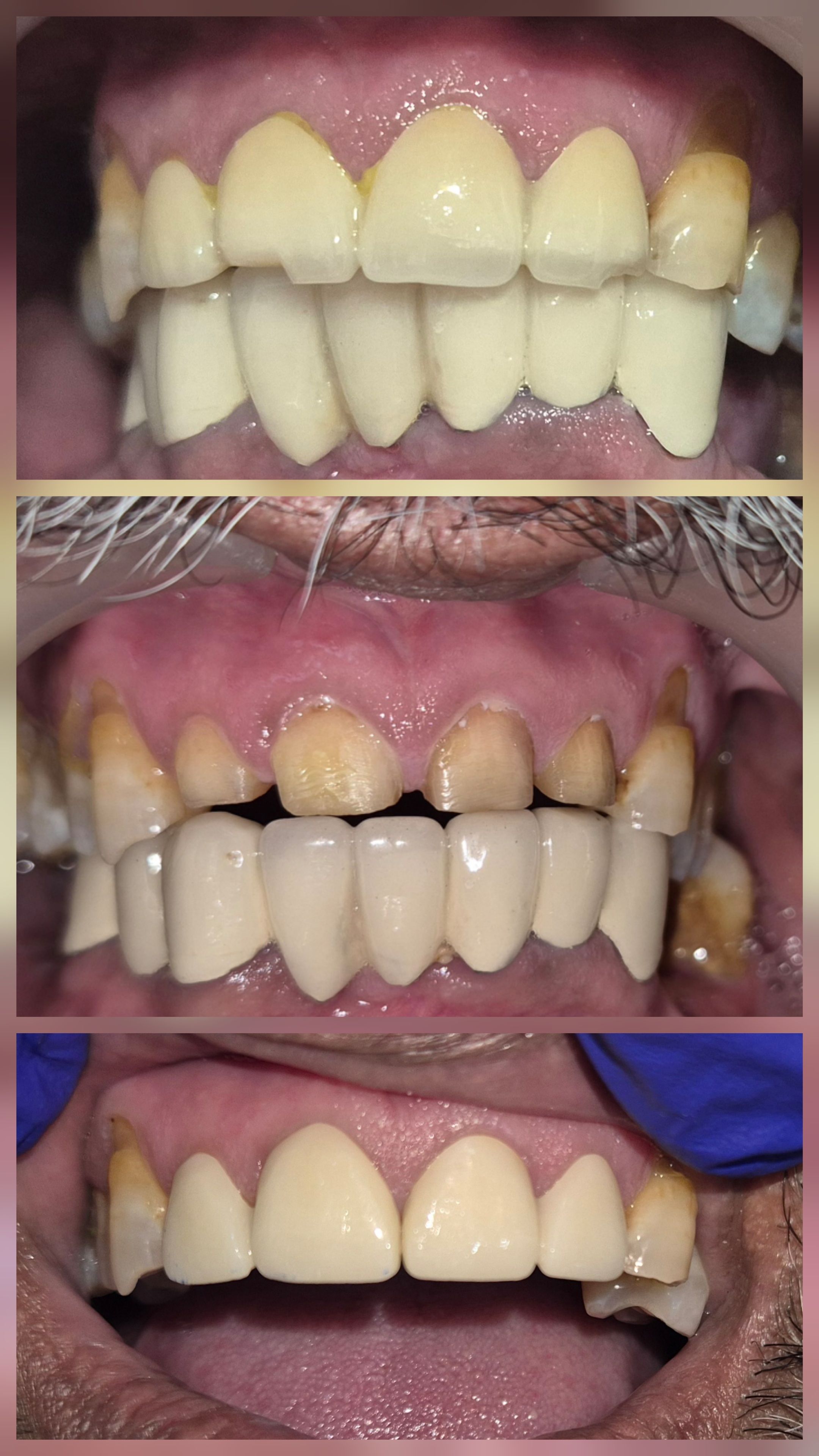 Spreading Smilez-Dr Bhalla's Multispeciality Dental Clinic Zirakpur Chandigarh