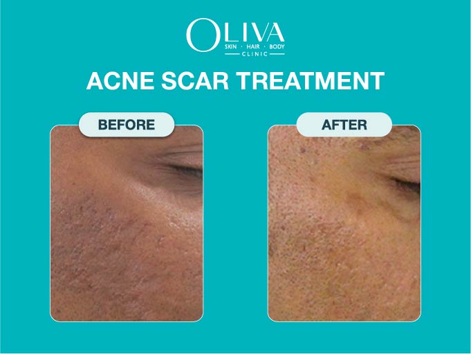 Oliva Skin Hair and Body Clinic Begumpet Hyderabad