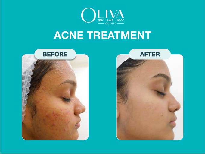 Oliva Skin Hair and Body Clinic Begumpet Hyderabad